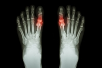 What to Do About Gout