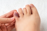 How to Tell if a Toe Is Broken