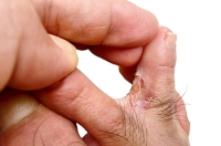Unmasking the Causes of Athlete’s Foot