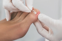 How to Deal With an Ingrown Toenail